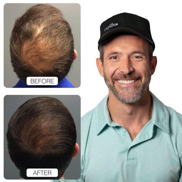 Capillus Hair & Skin Rejuvenation Bundle Online Sale - Image 4